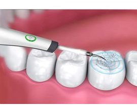 Ultrazvukový odstraňovač zubního kamene