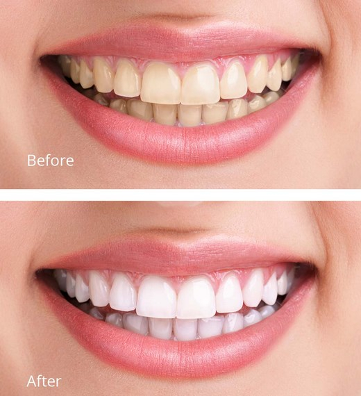 Krasaprozeny.cz - Domácí bělení zubů- originál bělící pásky Bright White  Professional - 28ks kúra na 14dnů - Bělení zubů - ZDRAVÍ, KRÁSA