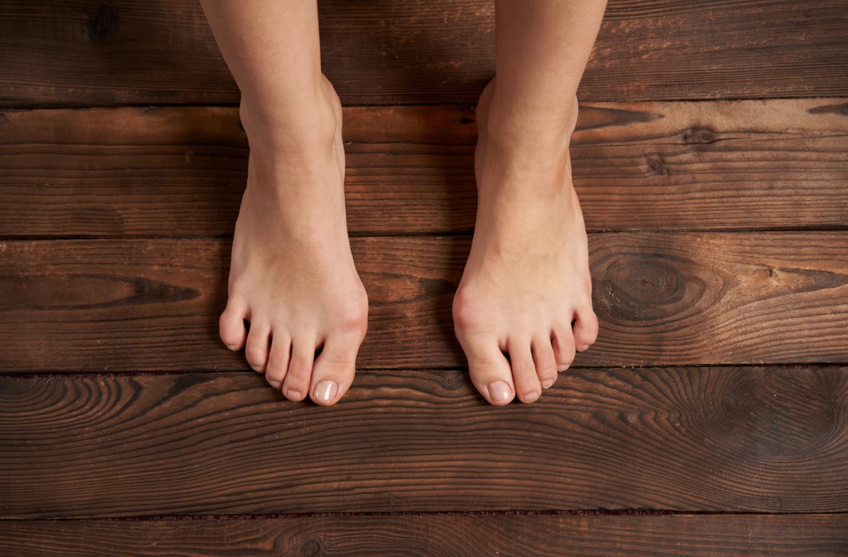 Hallux valgus – rodinné prokletí?