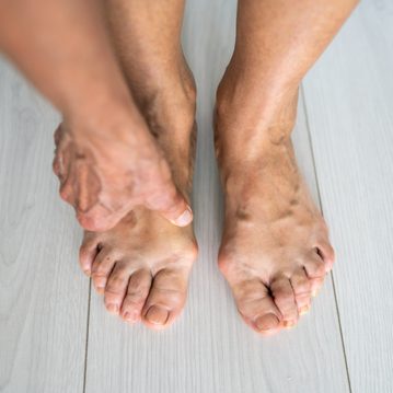 4/4 Vbočené palce pod kontrolou: Nejlepší metody prevence a léčby halluxů