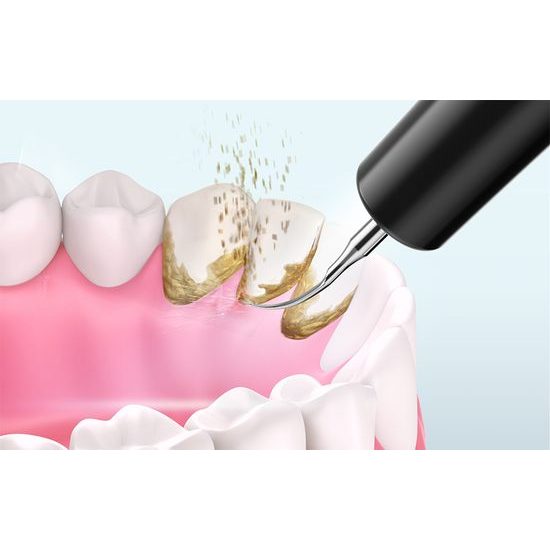 Fairywill FW-C8 ultrazvukový odstraňovač zubného kameňa, čierny