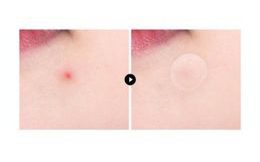 VT Obliži za akne Pro Cica Centella Asiatica Tiger Clear Spot Patch (66 kosov)