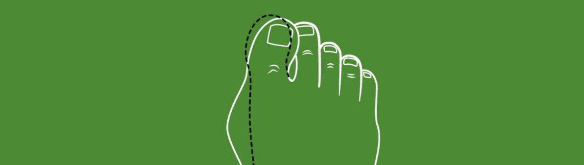 1/4 Hallux valgus und Barfußschuhe: Wann und warum ist „barfuß“ gehen sinnvoll?