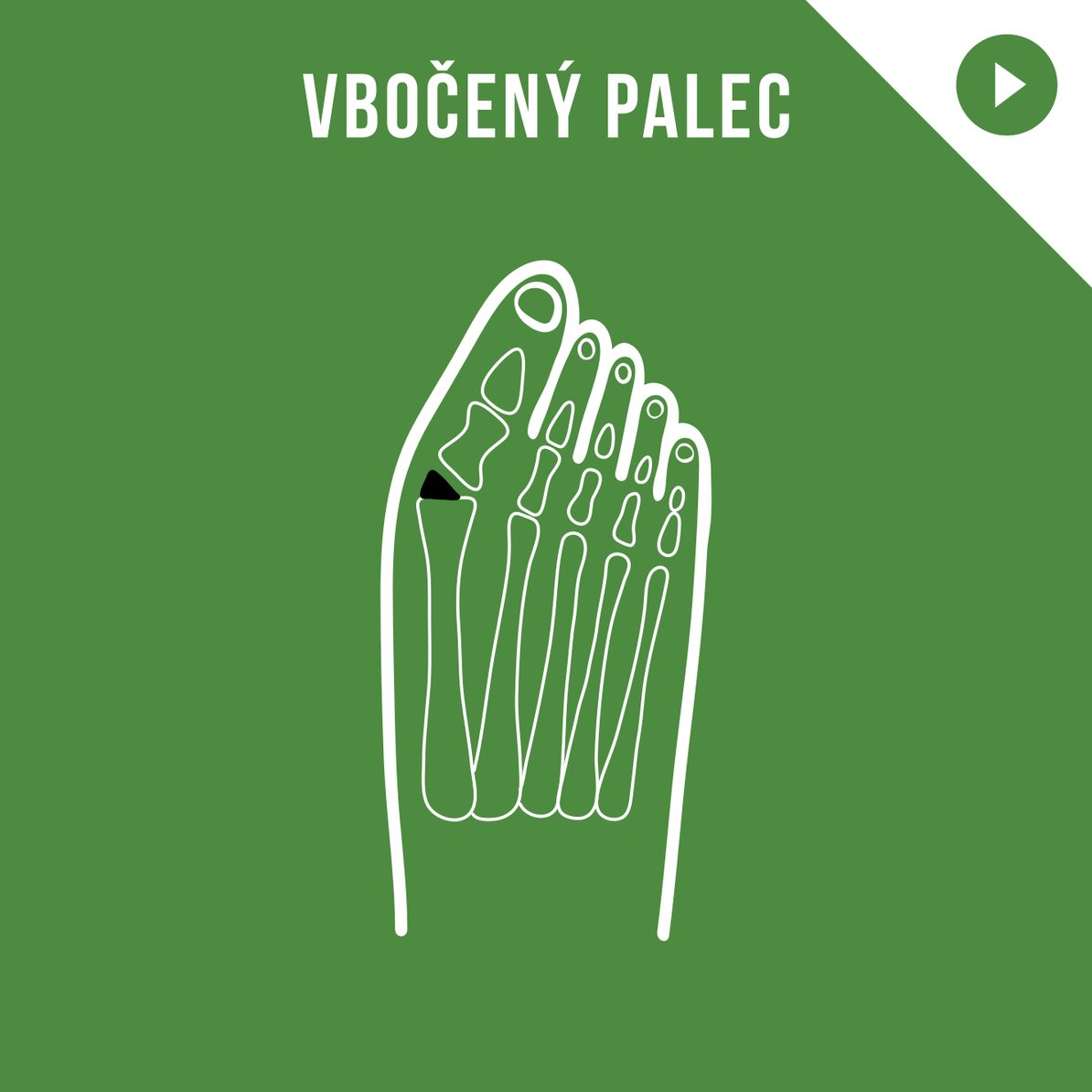 PODCAST: Bc. Edita Prošková: Vbočený palec pod lupou: Co způsobuje hallux valgus a jak mu předcházet?