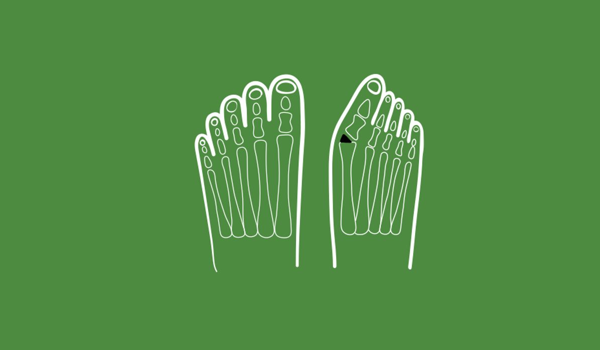 3/4 Hallux valgus under the microscope: what causes it and how to keep your feet healthy?