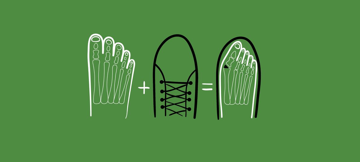 2/4 Hallux valgus? Die richtigen Schuhe können dein Leben verändern. So findest du sie