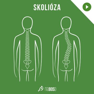 PODCAST: Mgr. Kristýna Šonská und Mgr. Olga Sidorenková: Skoliose