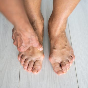 4/4 Hallux valgus im Griff: Die besten Methoden zur Vorbeugung und Behandlung
