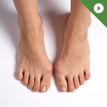 PODCAST: Bc. Edita Prošková: Vbočený palec pod lupou: Co způsobuje hallux valgus a jak mu předcházet?