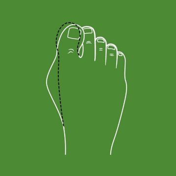 1/4 Hallux valgus und Barfußschuhe: Wann und warum ist „barfuß“ gehen sinnvoll?