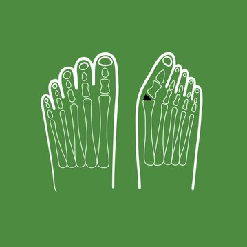 3/4 Hallux valgus unter der Lupe: Was ihn verursacht und wie du deine Füße gesund hältst?