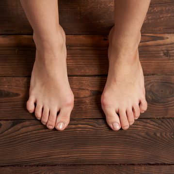 Hallux valgus – ein Familienfluch?