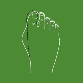 1/4 Hallux valgus und Barfußschuhe: Wann und warum ist „barfuß“ gehen sinnvoll?