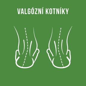 Valgusknöchel: Ursachen, Symptome und was du tun kannst