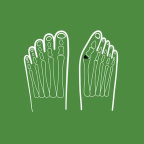 3/4 Hallux valgus pod lupou: Co ho způsobuje a jak si zachovat nohy zdravé?