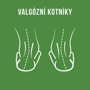Valgózní kotníky. Příčiny, příznaky a co s tím