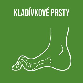Kladívkové prsty: Když nohy volají o pomoc – příčiny, prevence i řešení