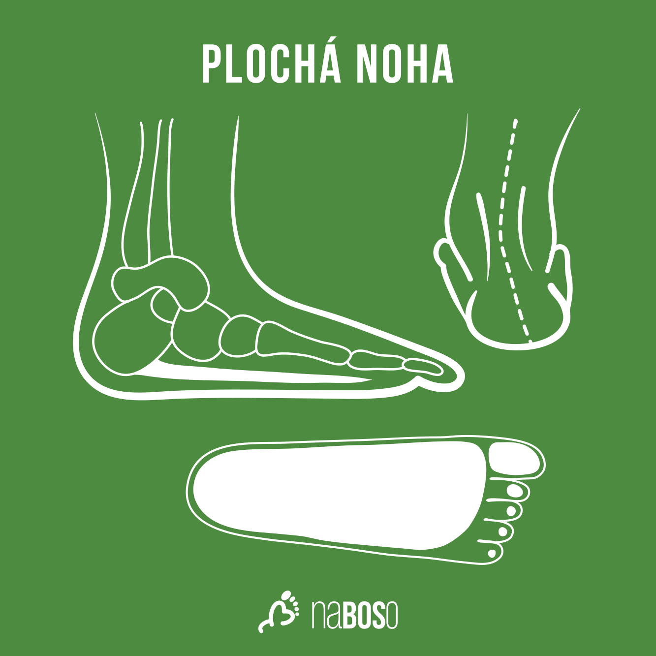 PODCAST: Bc. Edita Prošková: Plochá noha od diagnostiky po léčbu